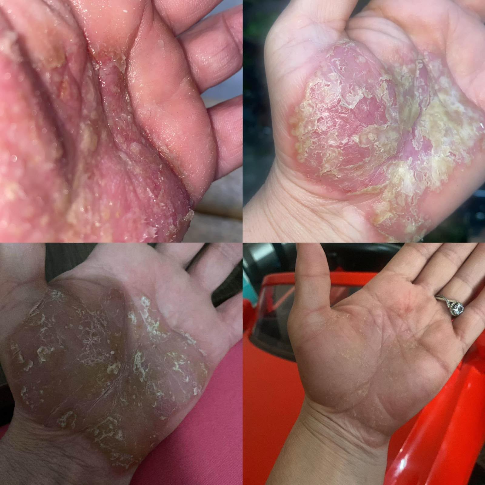Customer supplied skin wellness progress photographs from Wolverhampton